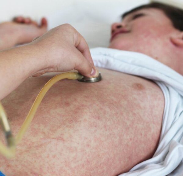 El tratamiento del sarampión consiste en controlar los síntomas hasta que el virus complete su ciclo