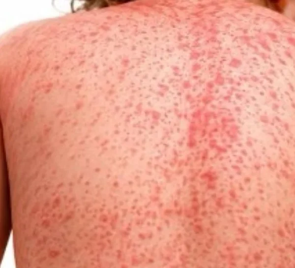 ¡Alerta epidemiológica! San Pedro Sula bajo estricta vigilancia sanitaria por nuevos casos de sarampión